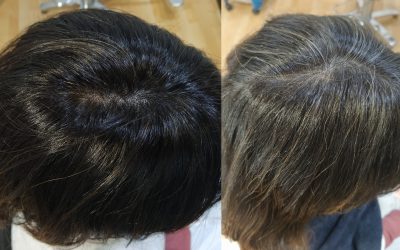  “Barros capilares en Granada: guía completa para saber si son para ti”